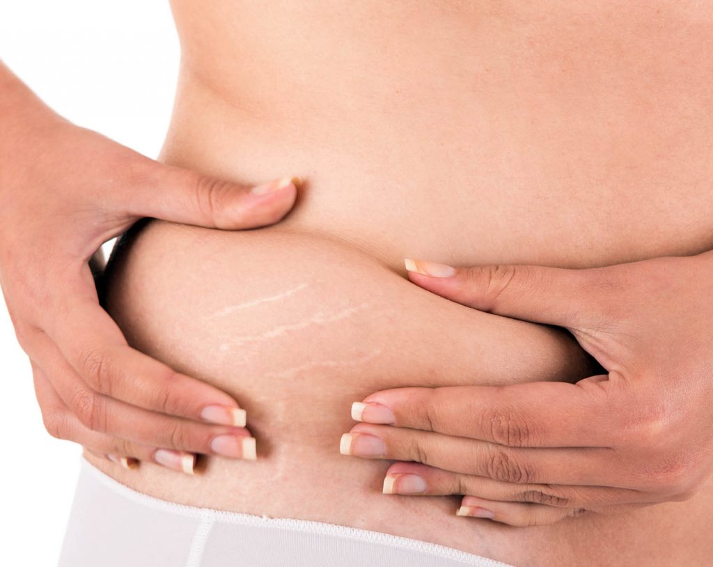 Woman showing her stretch marks