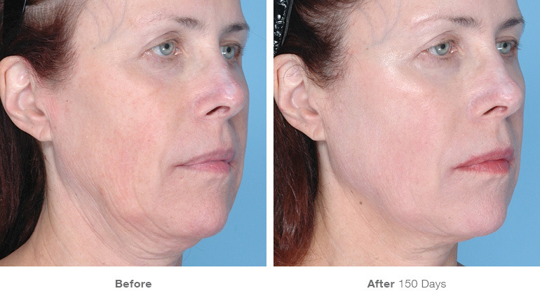 before_after_ultherapy_results_full-face22