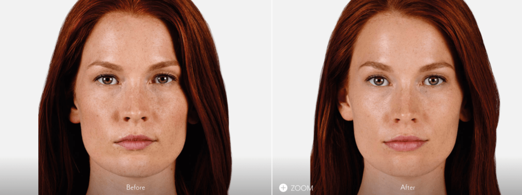 Fotos relleno de labios con ácido hialurónico antes y después