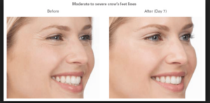 antes y después del tratamiento antiarrugas
