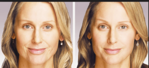 fotos antes y después del tratamiento antiarrugas