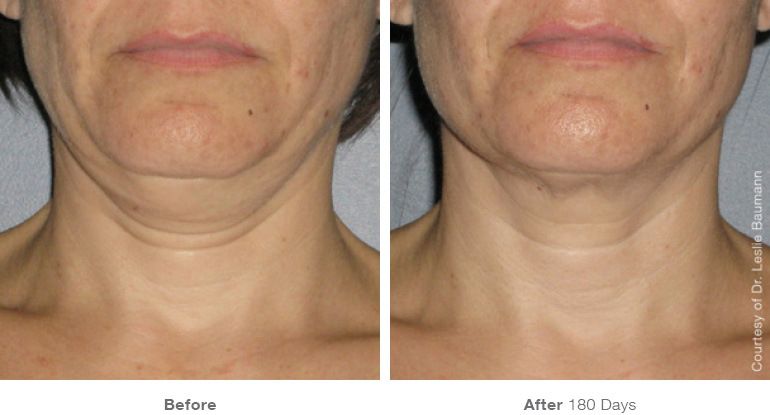 Antes y Después. Tratamiento en cuello con Ulthera