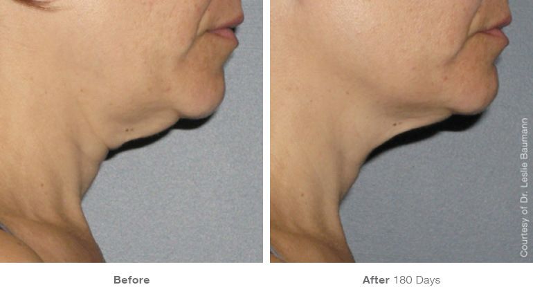 Fotos Antes y Después. Tratamiento en cuello con Ulthera