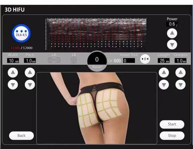 Por qué reducimos la grasa localizada con Hifu. Lipobarrido