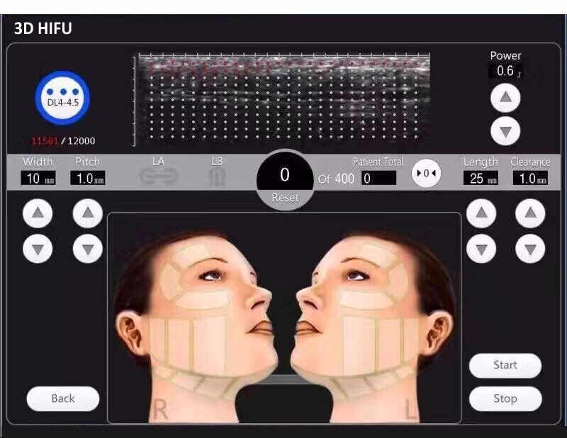 Por qué estiramos la piel de la cara con ultrasonidos HIFU