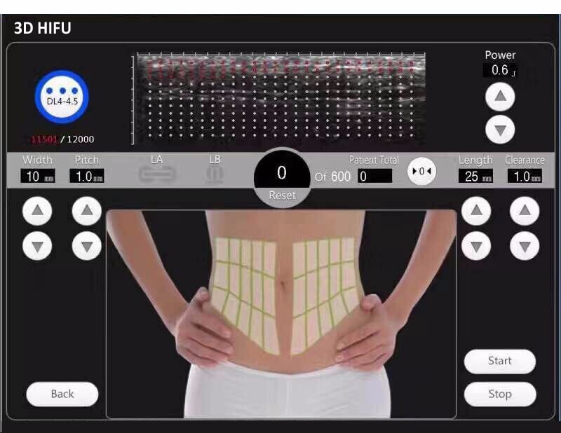 reducción de grasa con utrasonidos HIFU