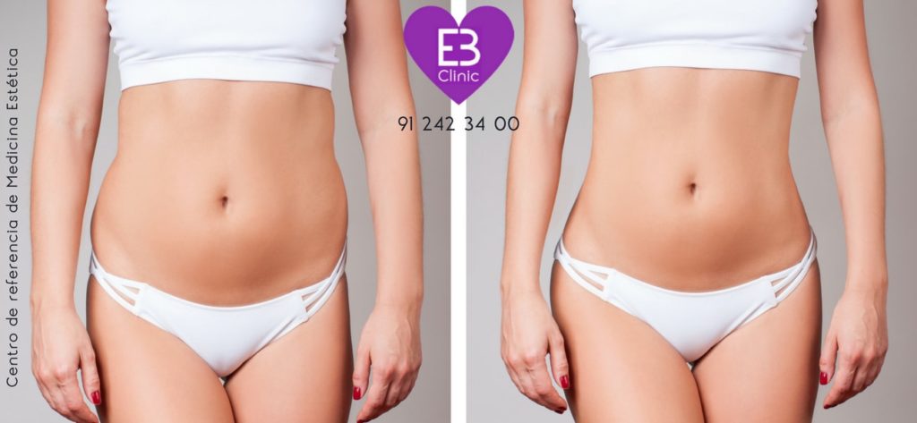 liposucción láser o laserlipólisis en Eternal Beauty Clinic