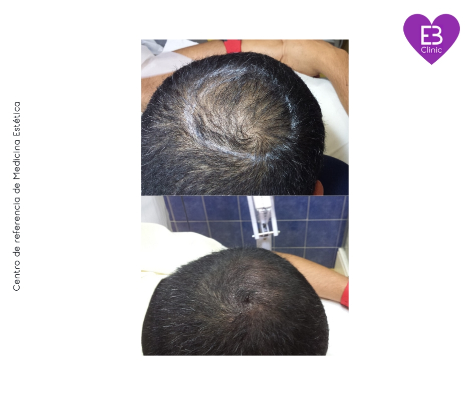 FOTOS ANTES Y DESPUES DE LA MICROPIGMENTACIÓN DE alopecia incipiente