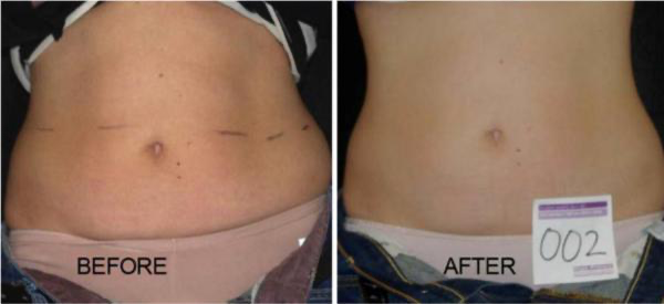 fotos antes y despues tratamiento lipolaser