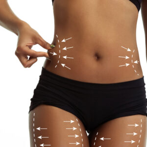 lipolaser nuevo tratamiento
