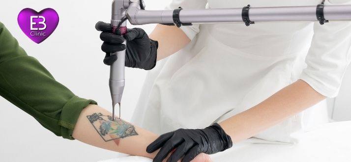 Láser Neodimio Yag para eliminación de tatuajes