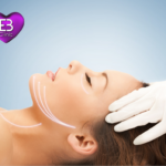 hilos tensores faciales