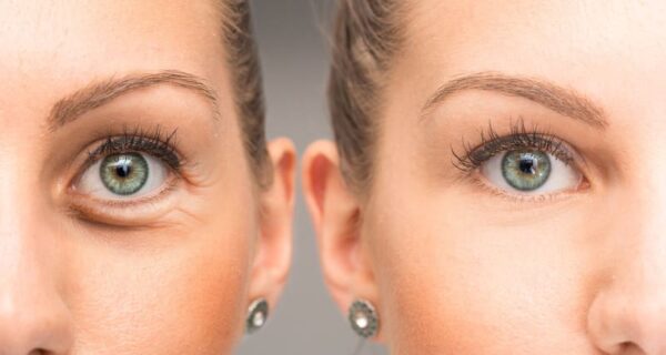 Tratamiento para las ojeras carboxyterapia