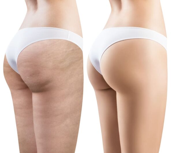 mesoterapia alidya piel de naranja piernas