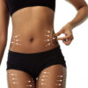Mesoterapia corporal en Eternal Beauty Clinic, Madrid