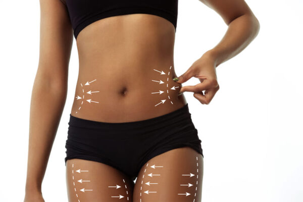 Mesoterapia corporal