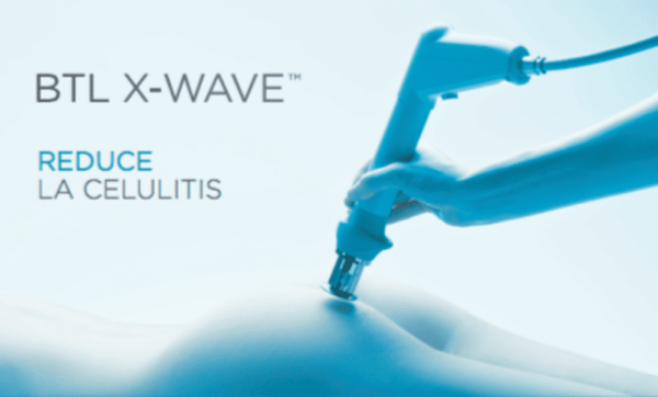 Tratamiento ondas de choque xwave en Madrid