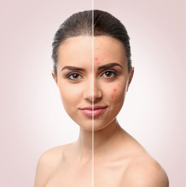 peeling químico