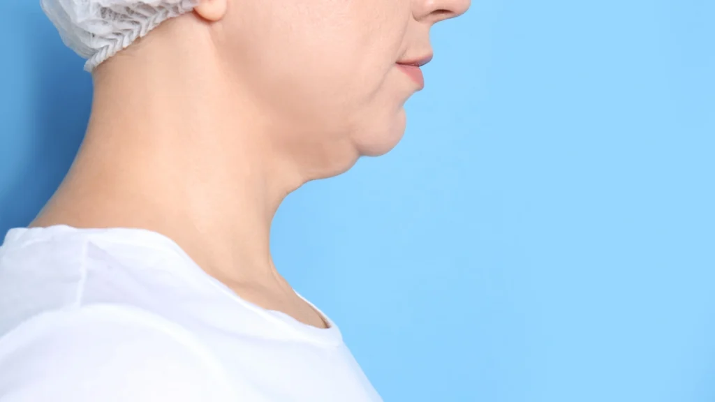 lipolaser para papada