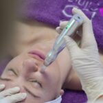 Rejuvenecimiento facial con exosomas y Dermapen
