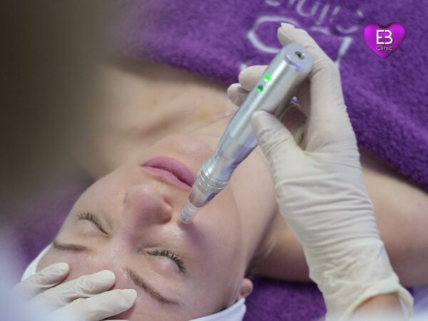 Rejuvenecimiento facial con exosomas y Dermapen