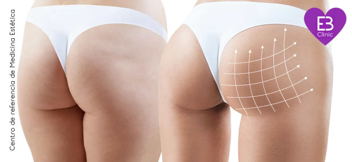 Cual fue mi experiencia con el tratamiento cellfina contra la celulitis – Eternal Beauty Clinic Madrid