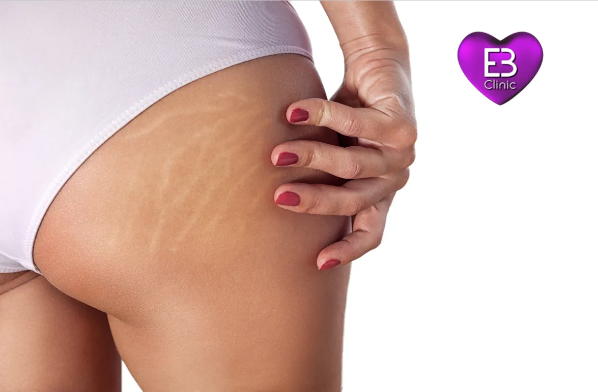 Dermapen con exosomas en Eternal Beauty Clinic Madrid