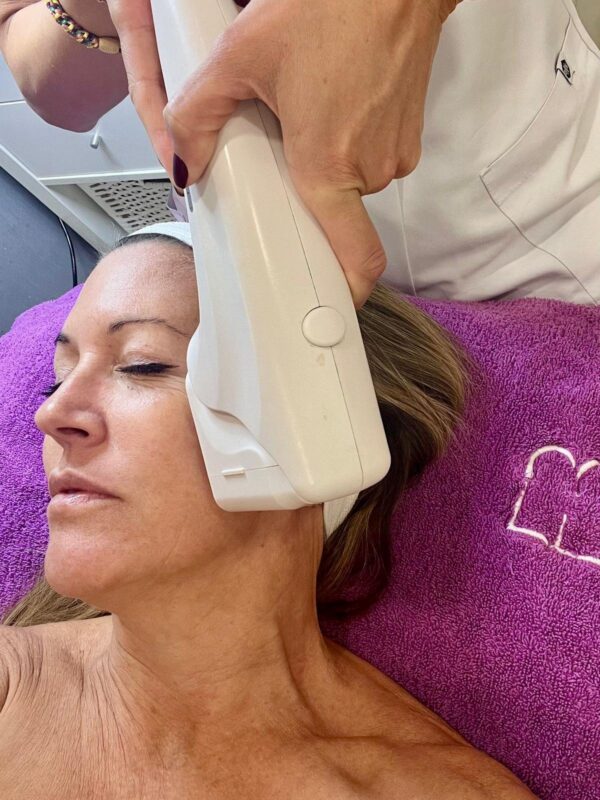 Sesión de HIFU facial sobre el pómulo en Eternal Beauty Clinic, Madrid