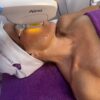 Sesión de luz pulsada intensa (IPL) con equipo Alma en Eternal Beauty Clinic, Madrid