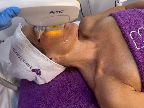 Sesión de luz pulsada intensa (IPL) con equipo Alma en Eternal Beauty Clinic, Madrid