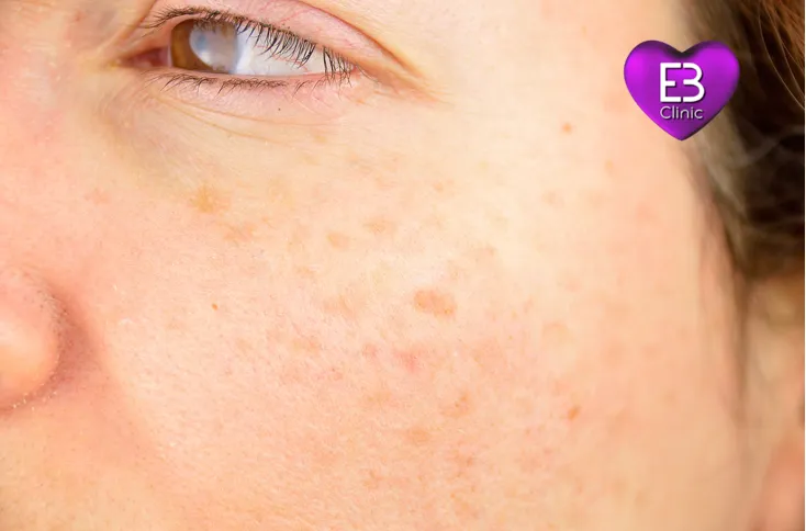 Manchas solares – Eternal Beauty Clinic Madrid