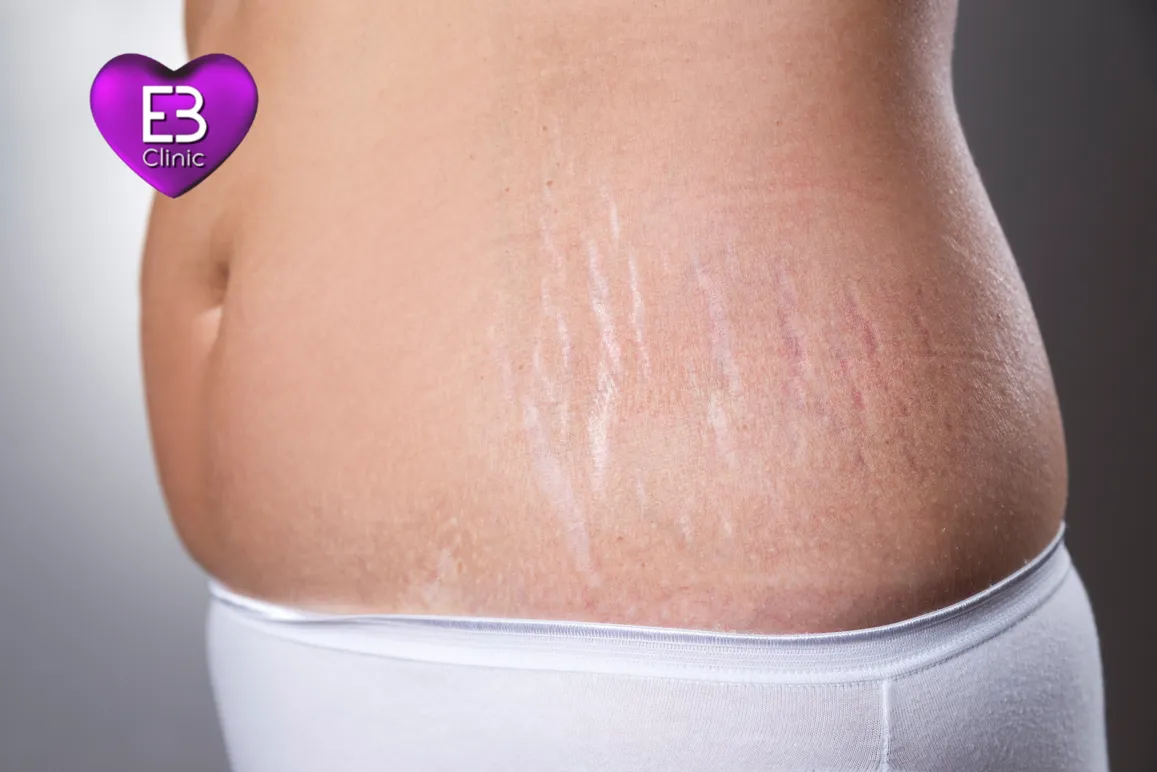 Tratramiento antiestrias embarazo jpg – Eternal Beauty Clinic Madrid